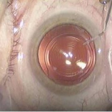 IOL refractive